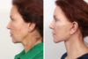 Blepharoplasty case #3563 slider thumbnail