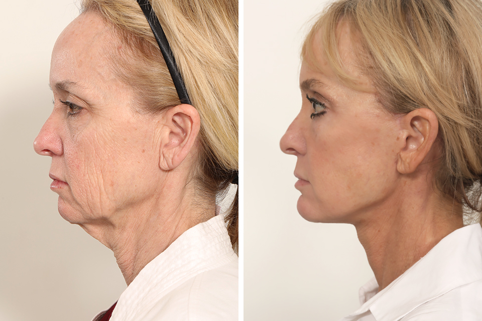 Blepharoplasty case #3555