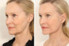 Blepharoplasty case #3567 slider thumbnail