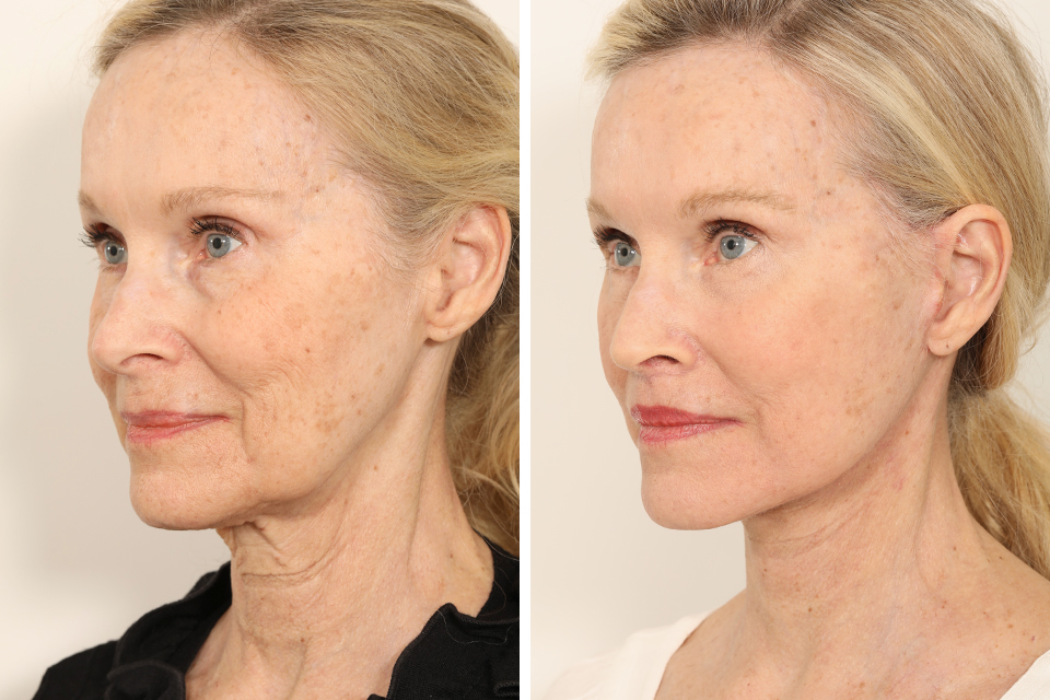 Blepharoplasty case #3567