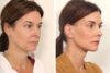 Blepharoplasty case #3559 slider thumbnail