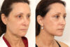 Blepharoplasty case #3578 slider thumbnail