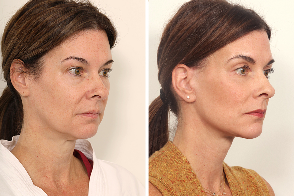Blepharoplasty case #3559