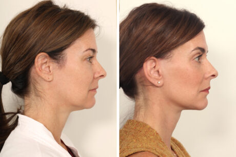 Blepharoplasty case #3559