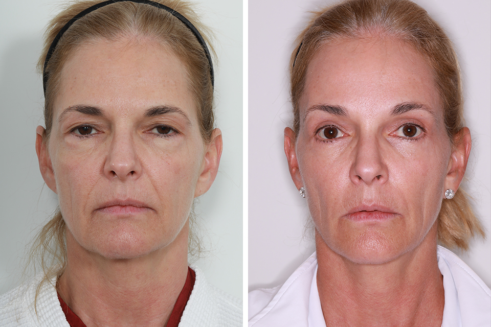Blepharoplasty case #3623