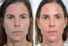 Blepharoplasty case #3644 slider thumbnail
