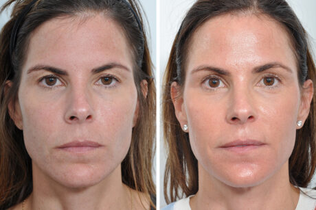 Blepharoplasty case #3644