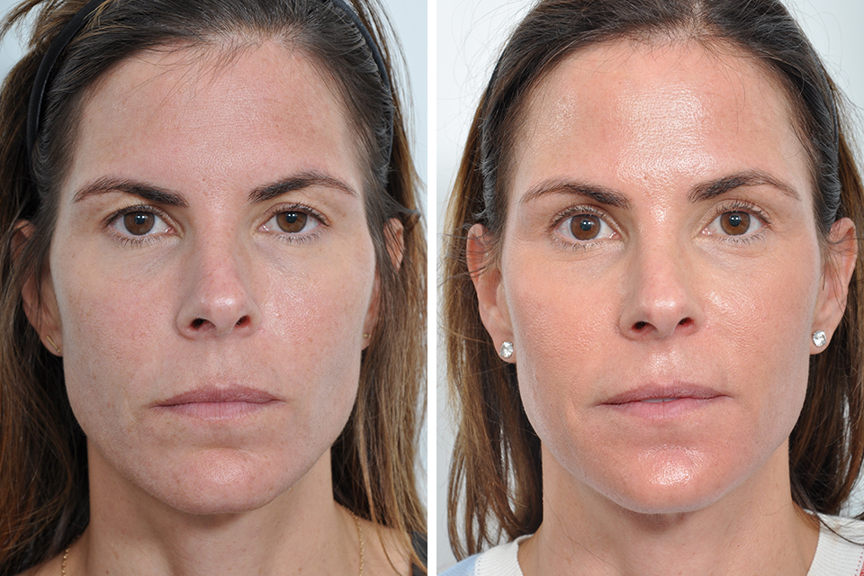 Blepharoplasty case #3644