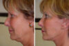 Blepharoplasty case #3639 slider thumbnail