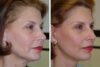 Blepharoplasty case #3637 slider thumbnail