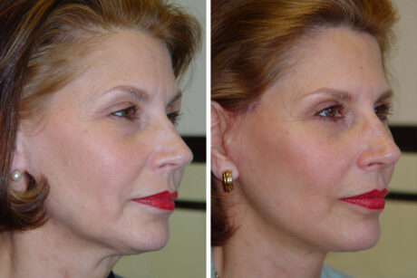 Blepharoplasty case #3637