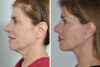 Blepharoplasty case #3650 slider thumbnail