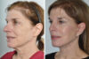 Blepharoplasty case #3650 slider thumbnail
