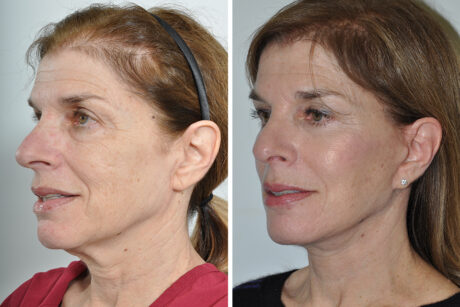 Blepharoplasty case #3650