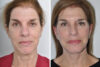 Blepharoplasty case #3650 slider thumbnail