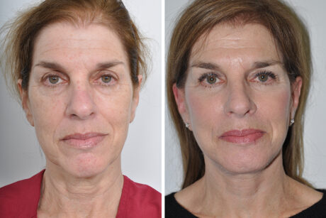 Blepharoplasty case #3650