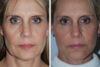 Blepharoplasty case #3646 slider thumbnail