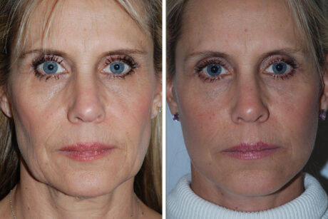 Blepharoplasty case #3646