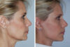 Blepharoplasty case #3646 slider thumbnail