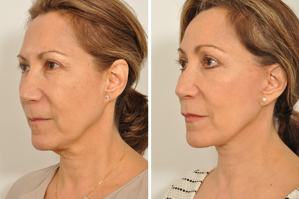 Blepharoplasty case #3617