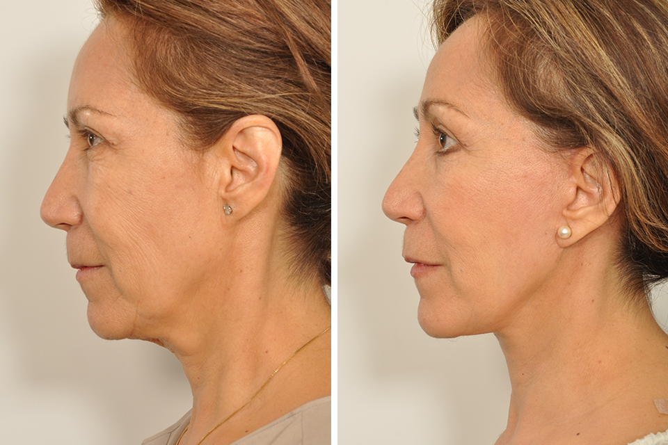 Blepharoplasty case #3617