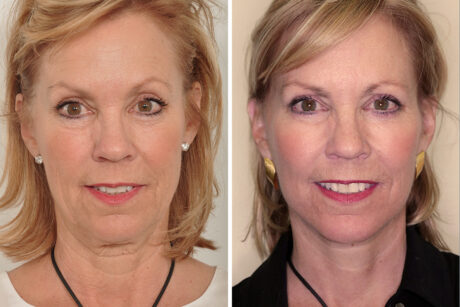Blepharoplasty case #3625