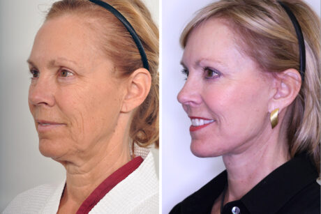 Blepharoplasty case #3627