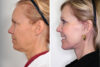 Blepharoplasty case #3627 slider thumbnail