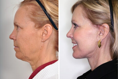 Blepharoplasty case #3627