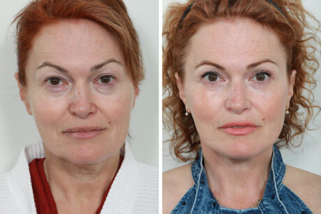 Blepharoplasty case #3599
