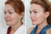Blepharoplasty case #3599 slider thumbnail