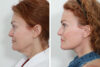 Blepharoplasty case #3599 slider thumbnail