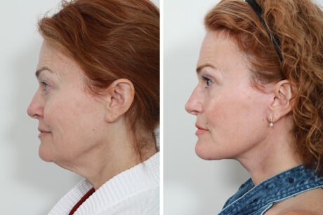 Blepharoplasty case #3599