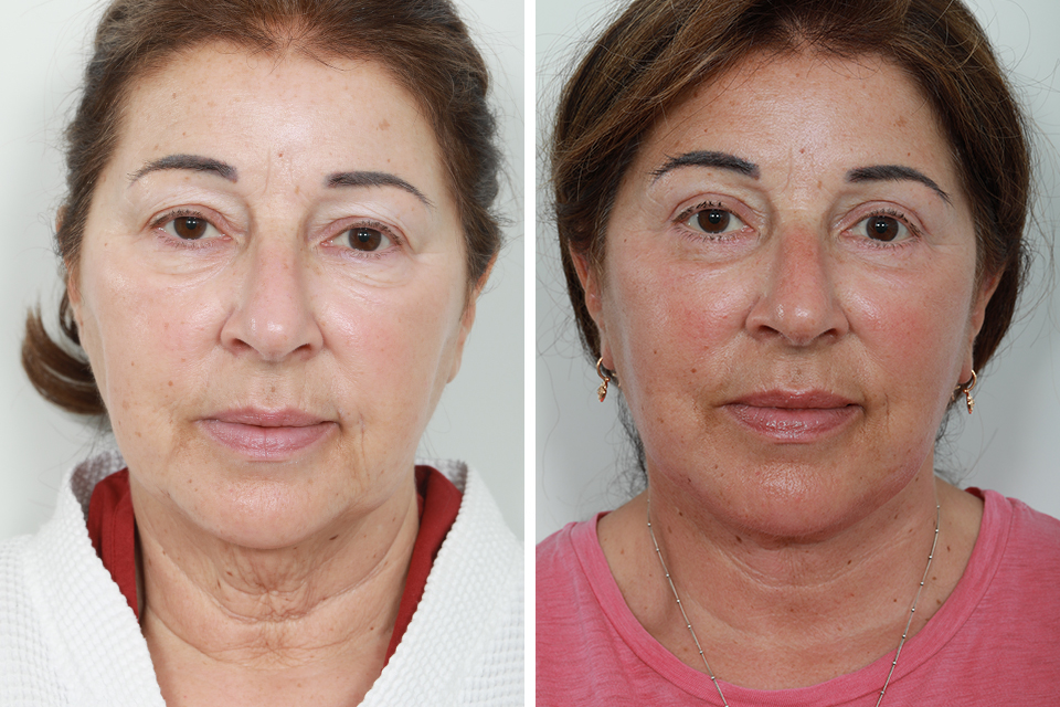 Blepharoplasty case #3613