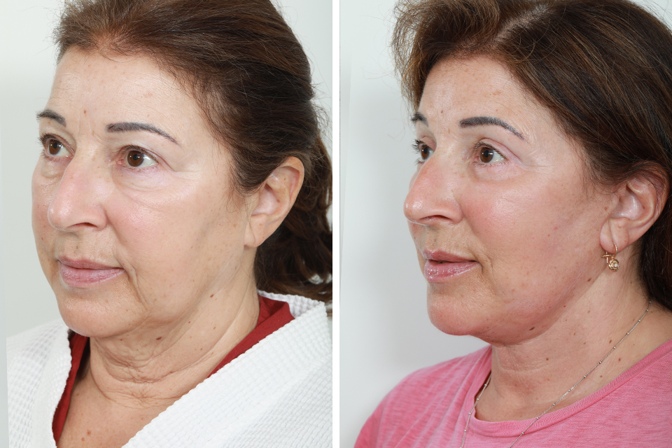 Blepharoplasty case #3613