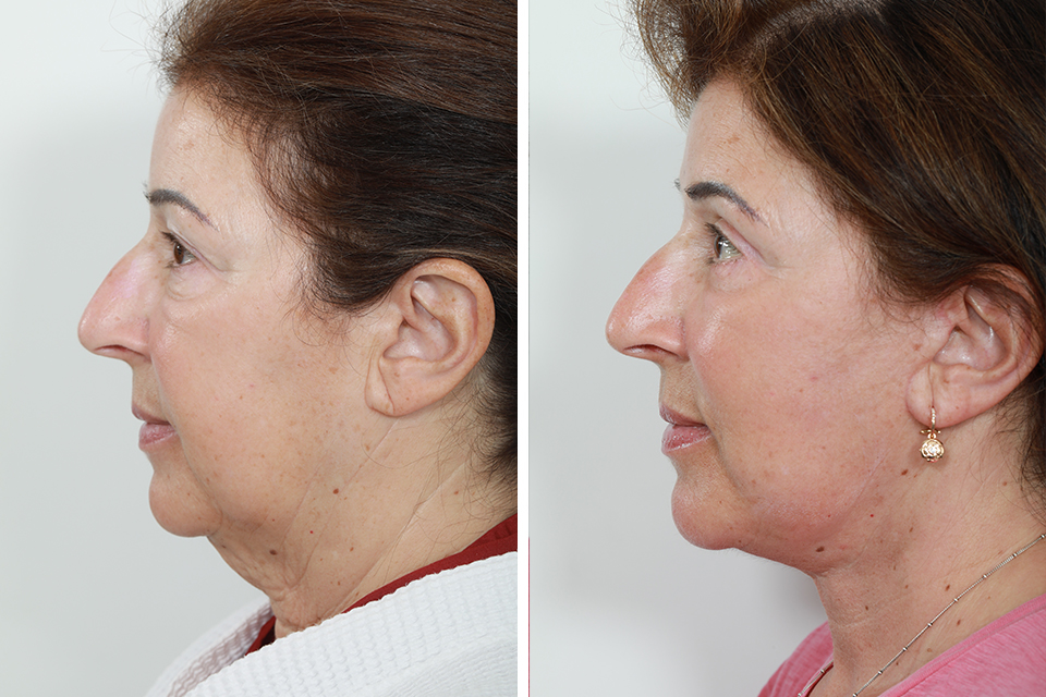 Blepharoplasty case #3613