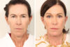 Blepharoplasty case #3550 slider thumbnail