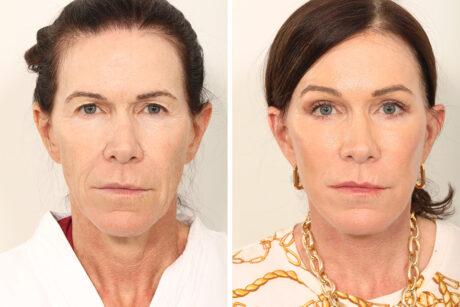 Blepharoplasty case #3550
