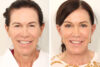 Blepharoplasty case #3550 slider thumbnail