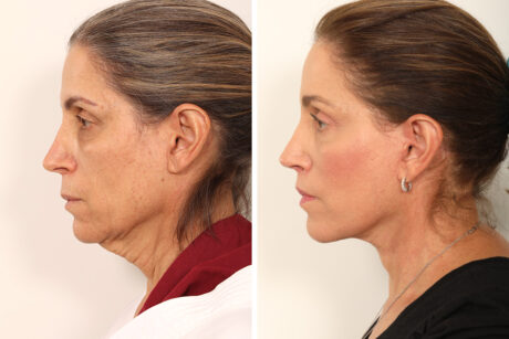 Blepharoplasty case #3588