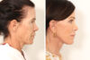 Blepharoplasty case #3550 slider thumbnail