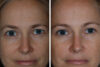 Blepharoplasty case #3635 slider thumbnail