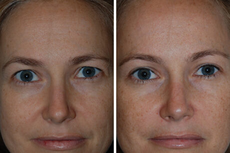 Blepharoplasty case #3635