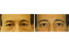 Blepharoplasty case #3323 slider thumbnail