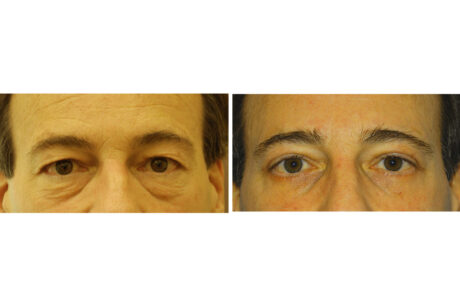 Blepharoplasty case #3323