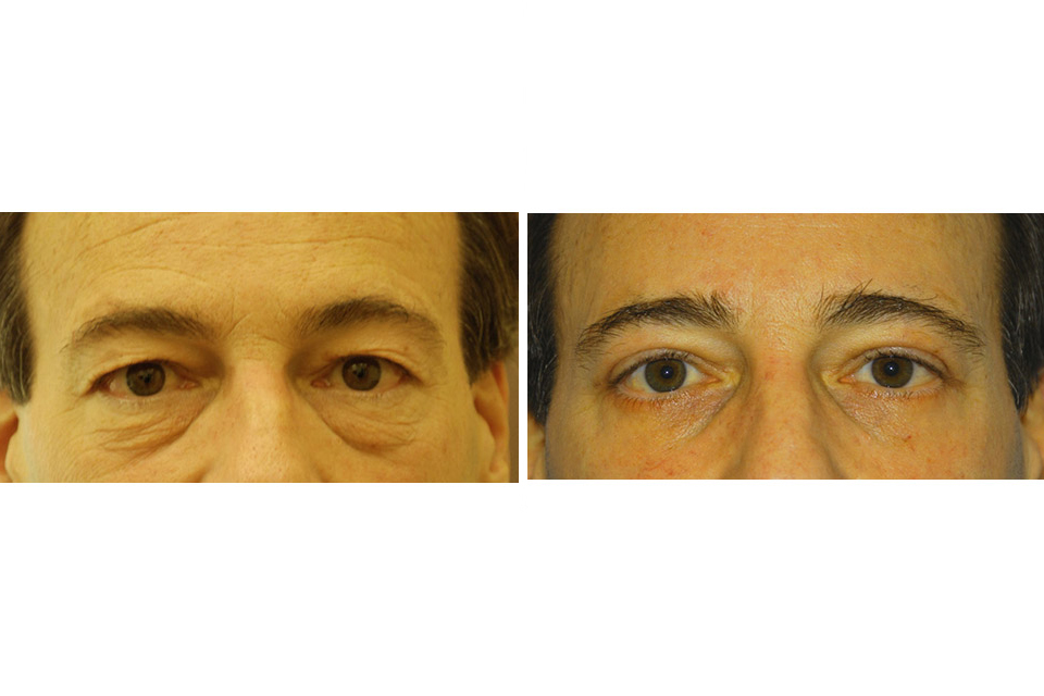 Blepharoplasty case #3323