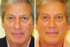 Blepharoplasty case #3407 slider thumbnail