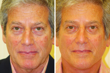 Blepharoplasty case #3407
