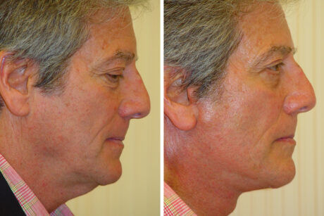 Blepharoplasty case #3407