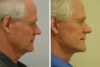 Blepharoplasty case #3414 slider thumbnail